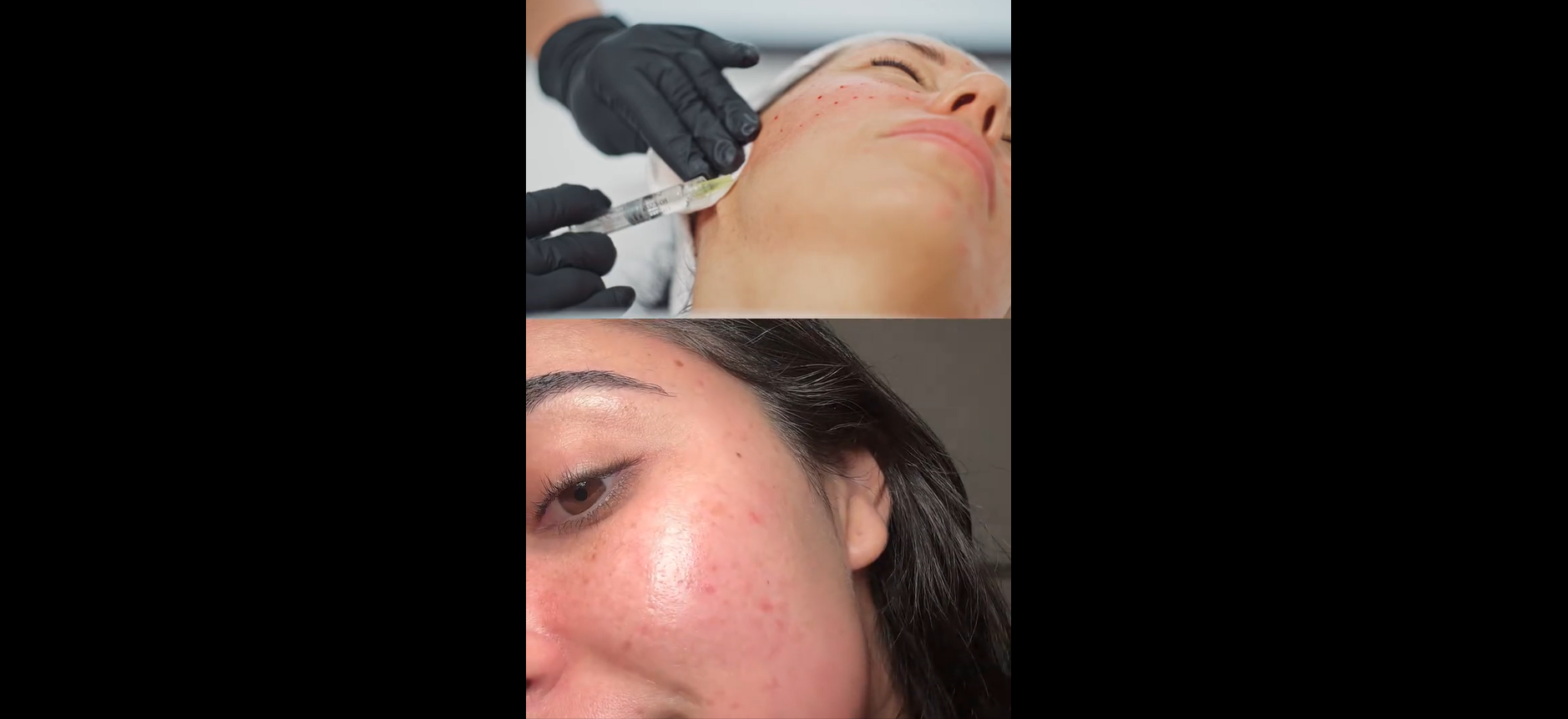 Amazon.com : COSRX 5 PDRN Hyaluronic Acid Vital Hydrating Hydrogel